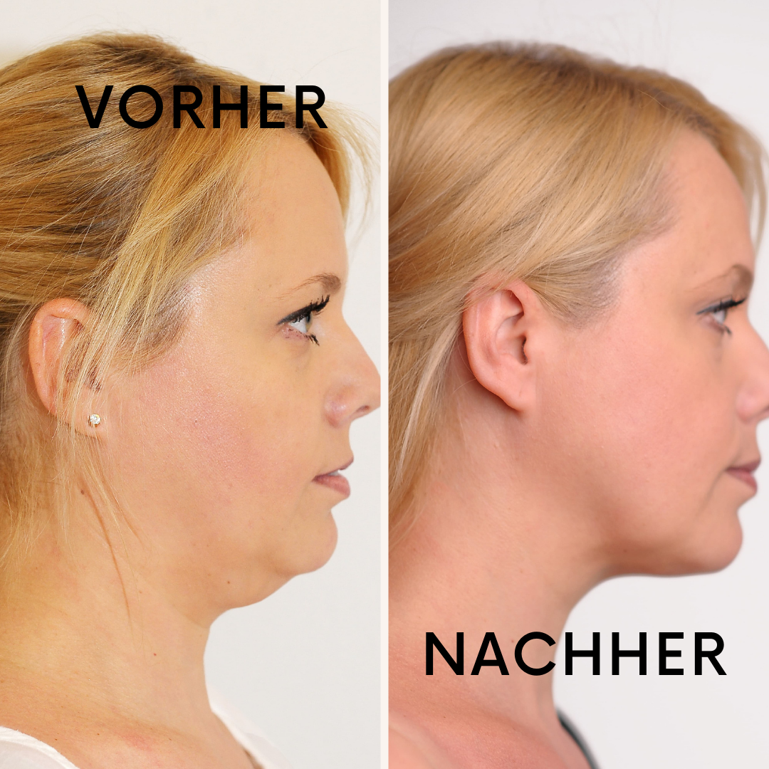 VivaLift: Definierte Kinnlinie & straffe Haut