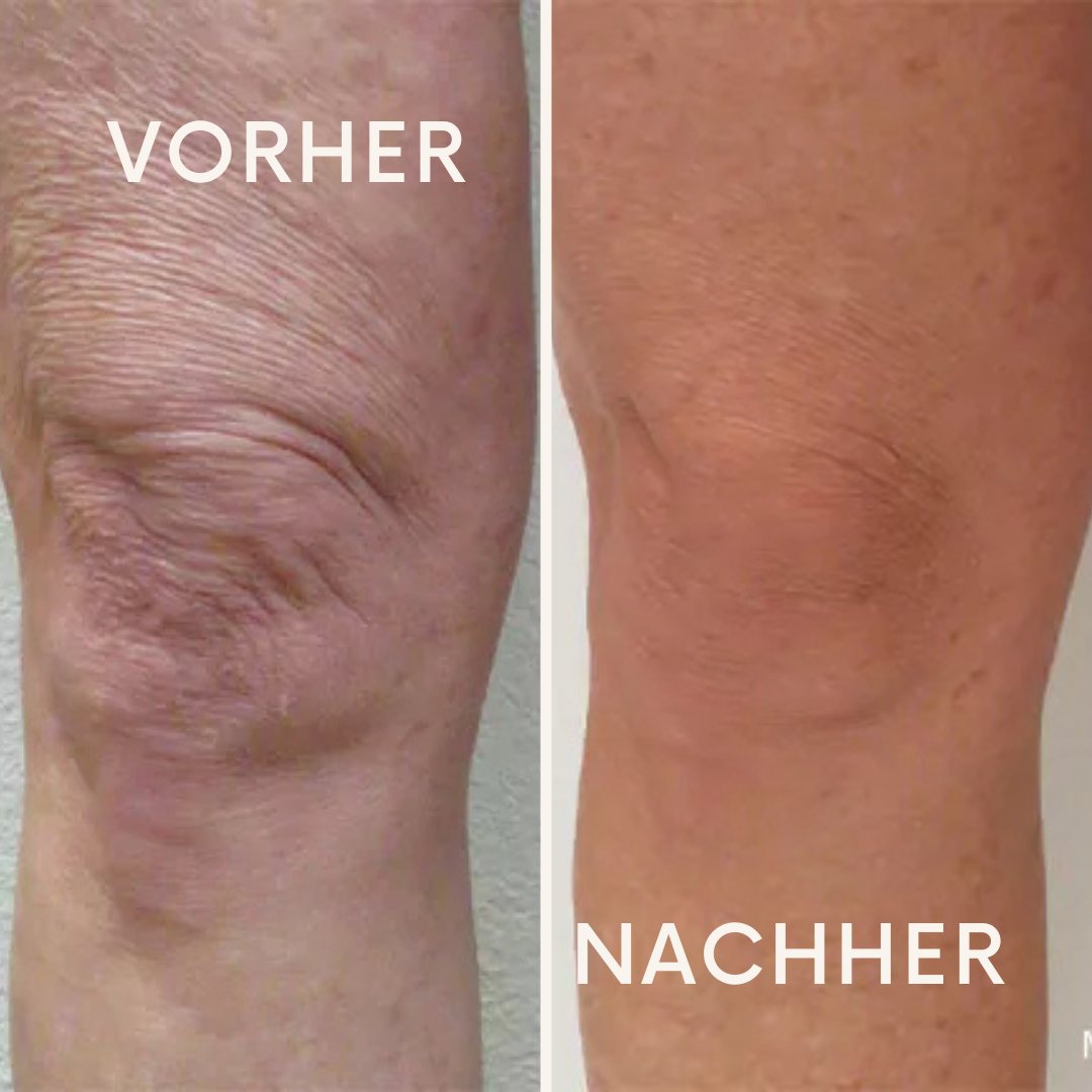 ErgoStride: Schluss mit Ischias-Drama