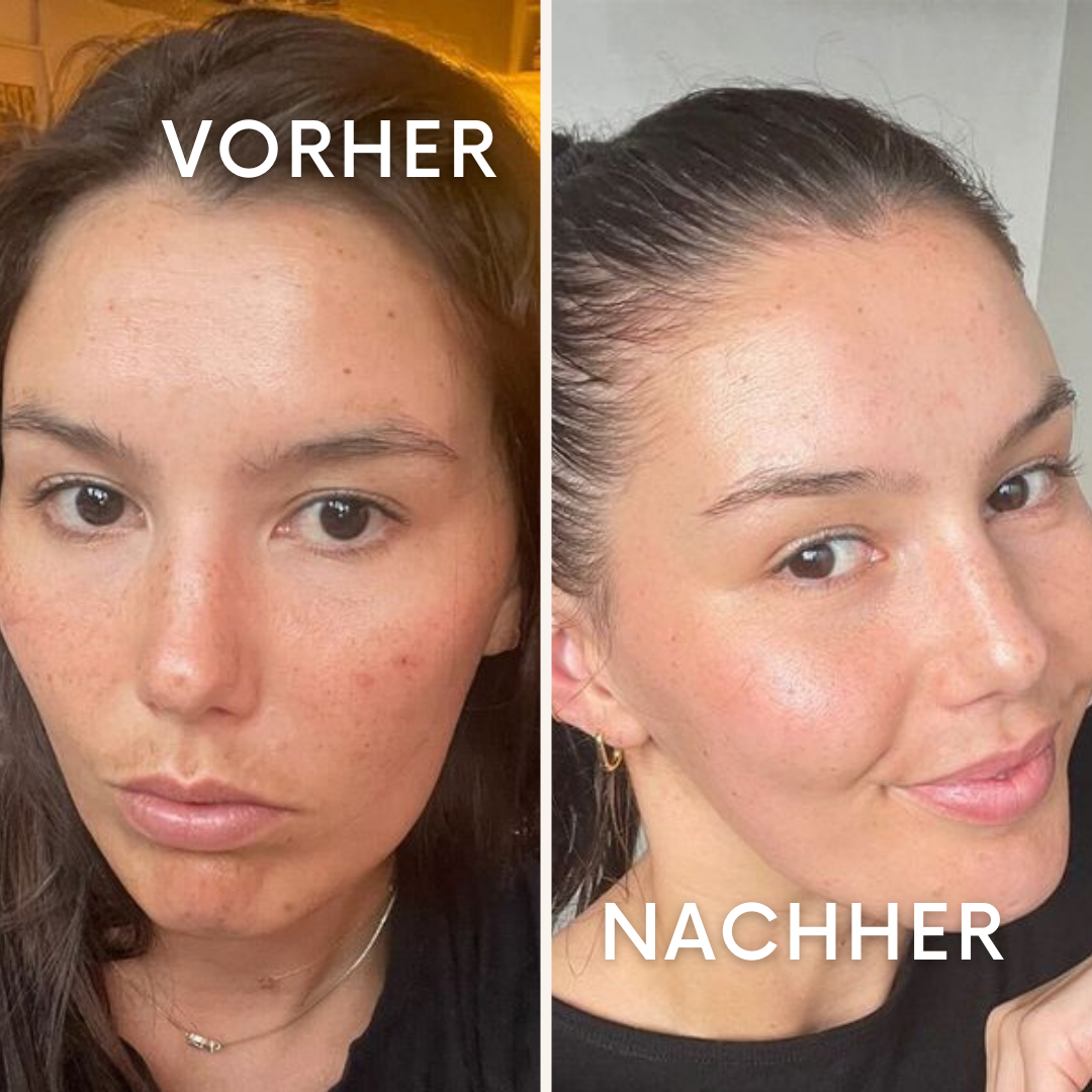 ScarEase: Die unsichtbare Lösung für deine Narben