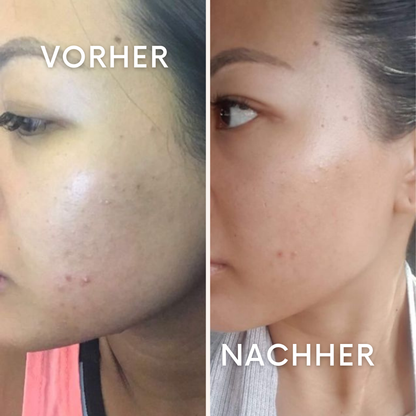 PoreNova: Ready für saubere Haut?