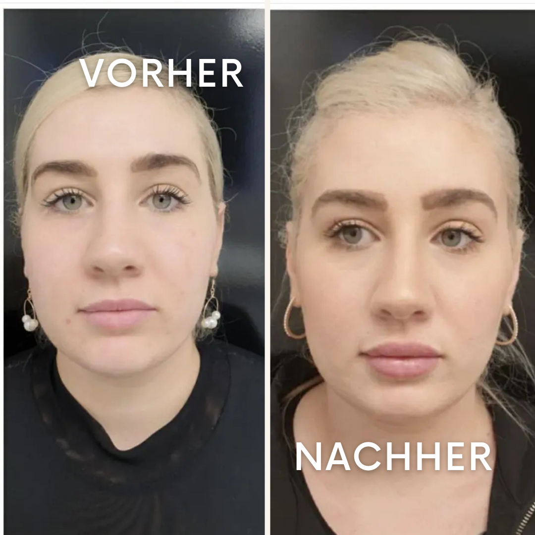 VibeLift: Für definierte Gesichtszüge