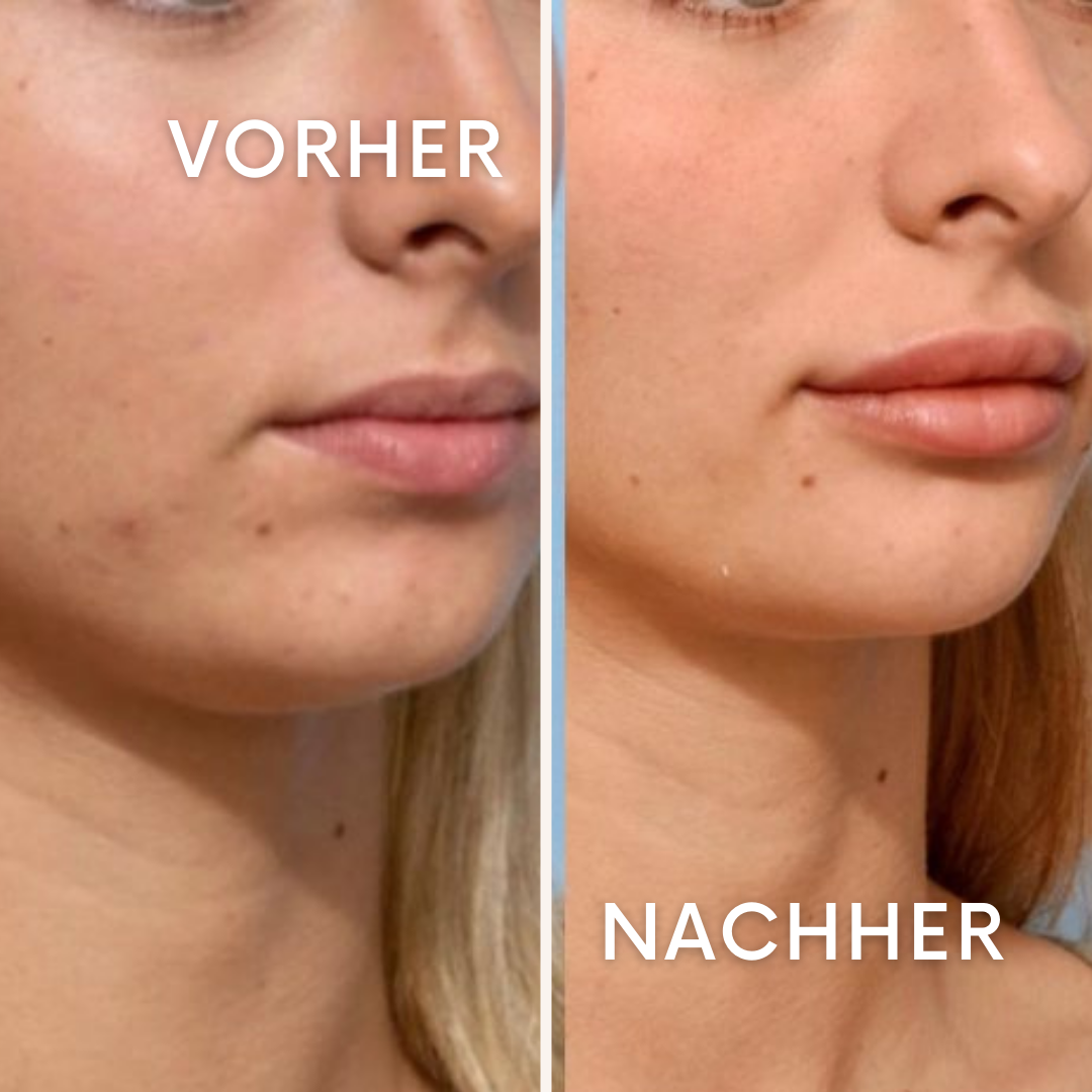 Sculptura: Lifting ohne Skalpell