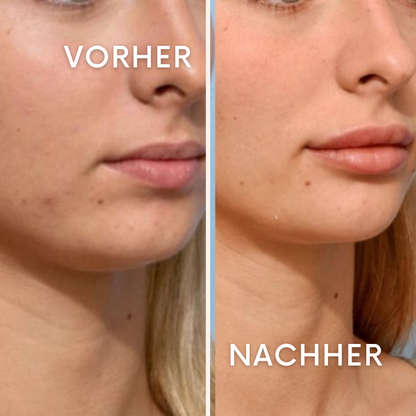 Sculptura: Lifting ohne Skalpell