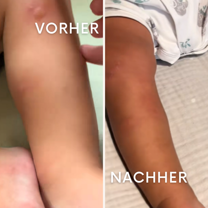 MozziPatch: Der Sommer, der dich nicht mehr sticht