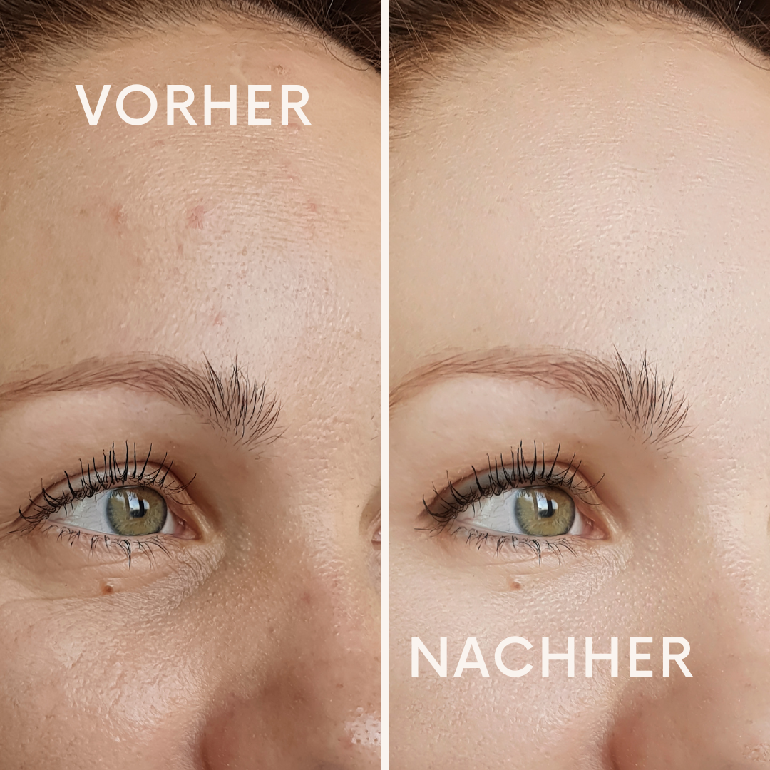 SkinFusion Roller
